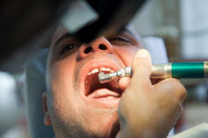 dentist fixing a broken tooth